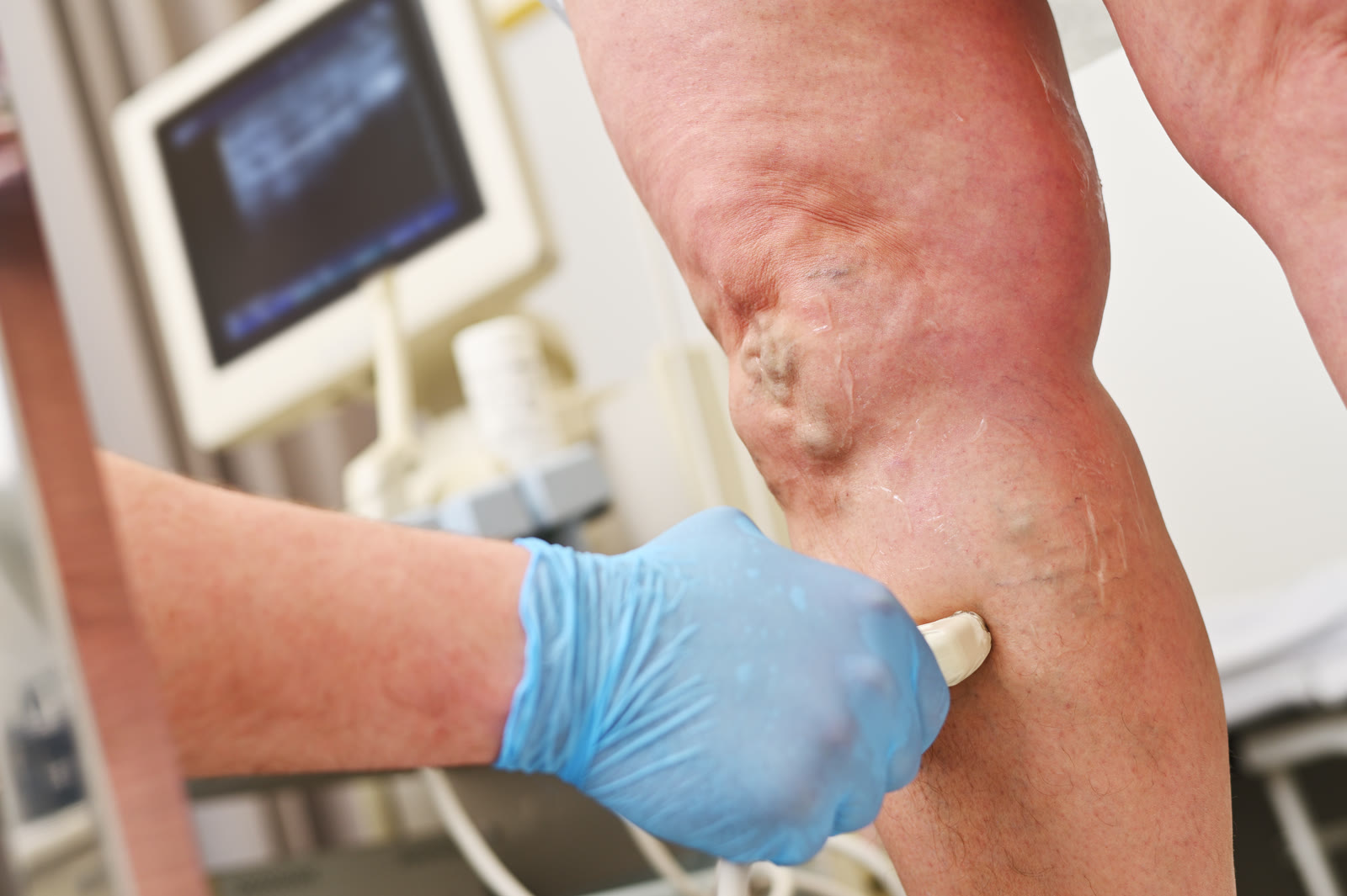 Peripheral Vascular